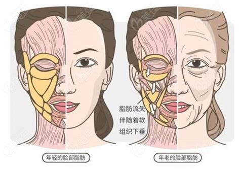 面部除皱需要多少钱，面部除皱手术的费用