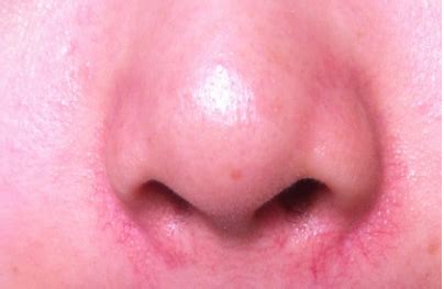 鼻子两边有红血丝是怎么回事，鼻子两边出现红血丝的原因