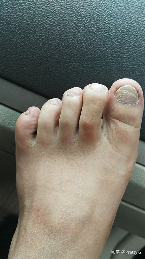 为什么脚趾甲会变厚，脚部受伤／真菌感染／老年人